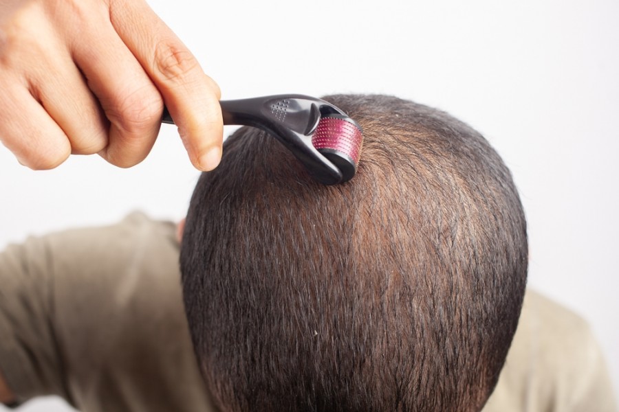 Comment stimuler la repousse des cheveux après une chimiothérapie ?